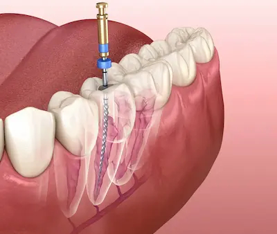 Endodoncias en Arahal, Sevilla
