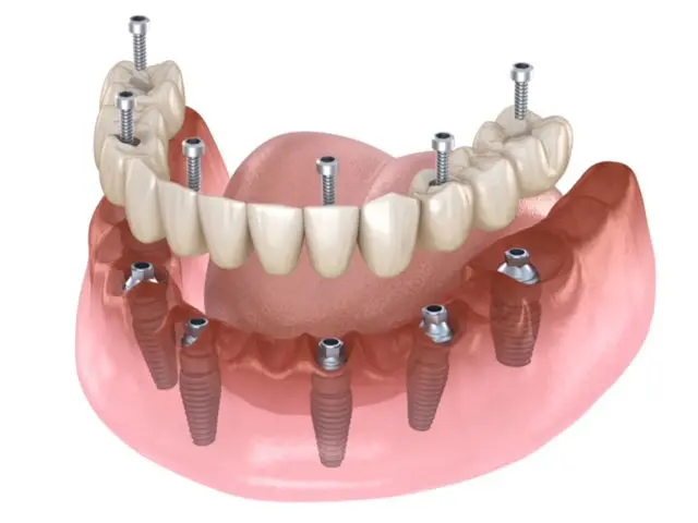 Protesis fijas en Arahal, Sevilla
